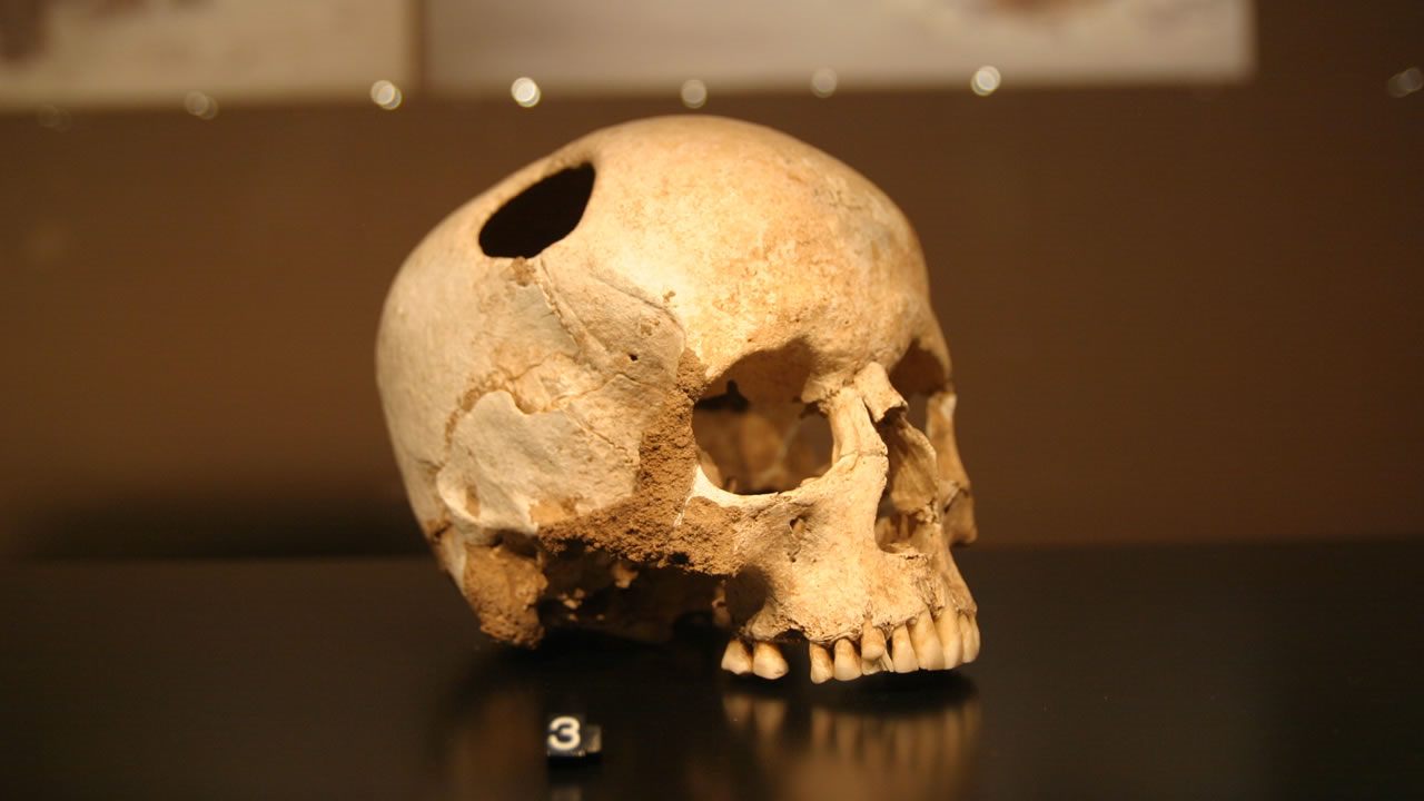 Los Incas hicieron mejores cirugías craneales que los cirujanos de EE.UU. 400 años después